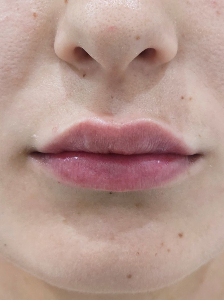 After lip fillers